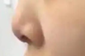 为什么这么多人都不选择L型硅胶假体隆鼻