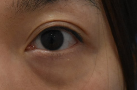 祛眼袋肿胀淤青明显吗？恢复期多久？-50508