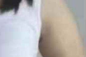 手臂吸脂术后恢复速度如何？恢复时间会不会很快？-50518