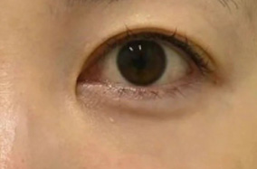 去眼袋和提眉手术可以同时进行吗-50517