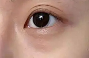 泪沟不及时治疗可能会成为你的累沟