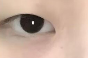 男士多层眼皮能修复吗？