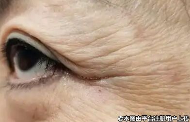 解锁鱼尾纹消除秘诀：注射点位与疗程安排全解析