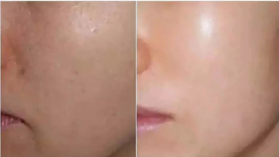 水光注射+热拉提：解锁肌肤逆龄的黄金密码