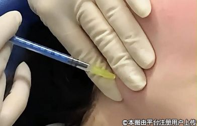 医美新风尚：玻尿酸+瘦脸注射，打造黄金拍档般的完美面容
