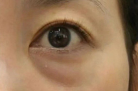 眼袋手术后会复发吗