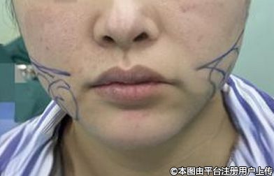 面部吸脂：破除非典型“衰老”枷锁，重焕青春光彩