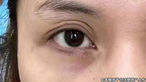 揭秘埋线双眼皮：究竟能维持多久？