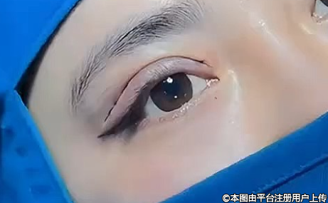 全切双眼皮能维持多久？深度剖析其持久性奥秘