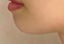 15岁的男孩可以做填充垫下巴吗
