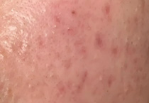 夏季战痘行动，净颜出击