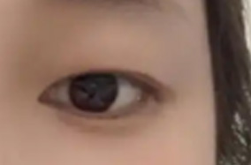 双眼皮手术有多热门？从刚成年到四五十岁，都有人在问-51039