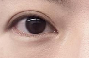 双眼皮没割好？到底该怎么修复