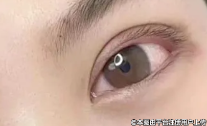 解锁双眼皮手术方式：找到专属你的“睛”彩之选