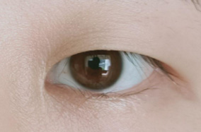 肿泡眼和眼突是一样的吗？会影响做双眼皮手术吗