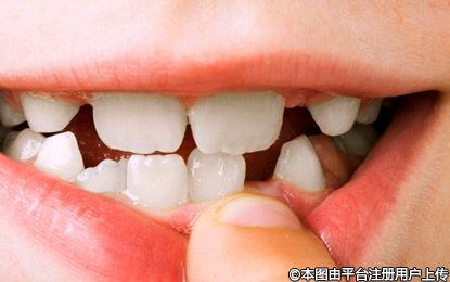 儿童牙齿矫正：把握黄金时期，守护灿烂笑容