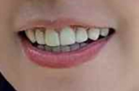 牙齿矫正为什么一定要戴保持器？