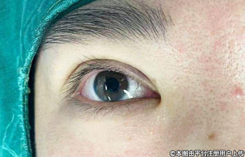 揭秘埋线双眼皮：效果究竟能维持多久？