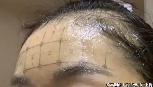热玛吉高价背后的真相：成本、效果与便捷的交织