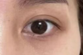 太阳穴凹陷，除了玻尿酸填充，还有这些方法-51110