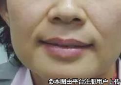 注射玻尿酸：美丽背后的潜在风险与应对之道