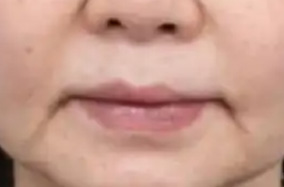 [重塑年轻轮廓]玻尿酸：专治亚洲脸
