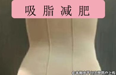 探秘吸脂手术：解锁常见吸脂部位的美丽密码