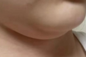 面部填充的脂肪可以通过面部吸脂吸出吗？-51188