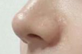 鼻整形L型假体和柳叶型假体有什么区别？-51373
