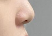假体、注射、自体隆鼻各有千秋，你该如何抉择？