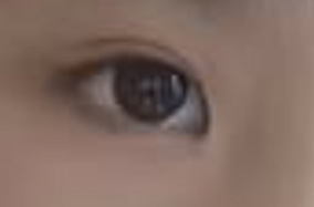 学生做双眼皮埋线需谨慎