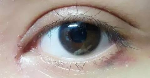 开眼角手术全解析：解锁双眸放大魅力的科学密码