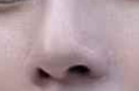 隆鼻手术后为啥鼻子会发红？