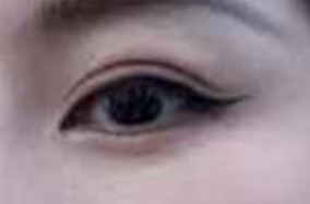 双眼皮手术：到底适合哪些人做？-51406