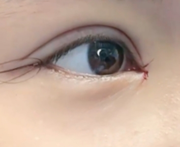 开眼角“魔法”：解锁眼部美丽新密码，这些问题统统搞定！