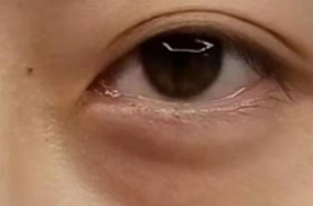 还在担心眼周衰老吗？这些问题需要注意！