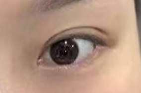 同样是7毫米的双眼皮，为什么看起来宽度差异这么大