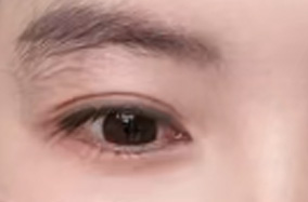 [科普]假期变美！如何避免双眼皮手术的常见陷阱