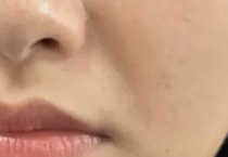 法令纹究竟是怎么出现的？又该如何消除呢