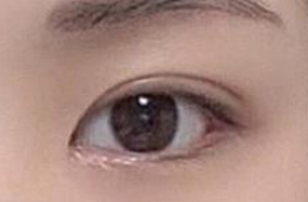 暑假，为什么是割双眼皮的好时机