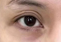 眼窝凹陷填充脂肪会有后遗症吗