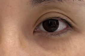 如何选择眼部填充材料和填充手法