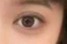 双眼皮手术年龄适配：不同阶段如何科学变美