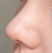 隆鼻后“美”不达标？别急，修复有门道但时机很重要！