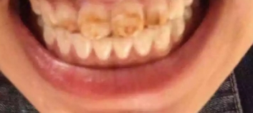 矫正前必知！这些检查一个都不能少，少走弯路变美更快！