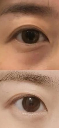 眼周整形手术“变美陷阱”？这些风险你必须提前知晓！
