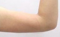 吸脂后就能轻松瘦？这些真相你必须知道！
