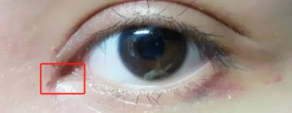 眼部手术感染率降低90%？掌握这5招让你安心变美！