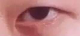 开眼角术后必看！拆线时间与护理指南全解析