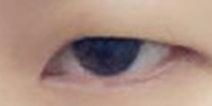 单眼皮变“电眼”的秘密武器！重睑术全解析：原理、效果与避坑指南